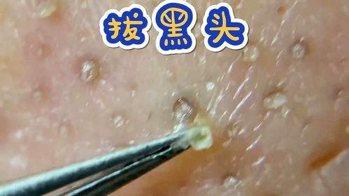 看挤粉刺视频,专业技巧与注意事项
