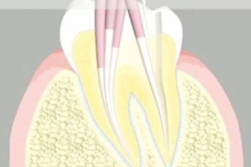 根管治疗视频演示