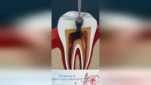 根管治疗视频演示